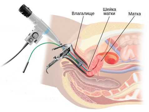 Цервикоскопия