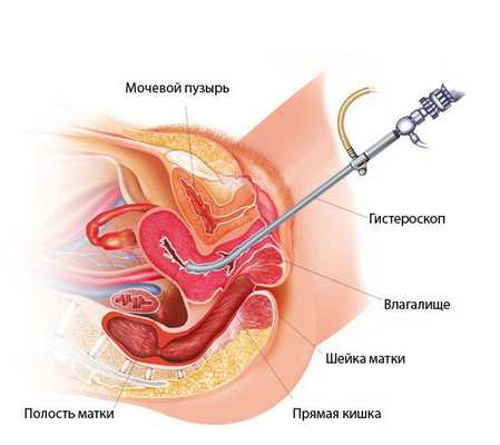 Гистероскопия