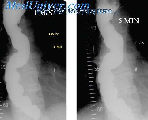 деструкция стенки пищевода