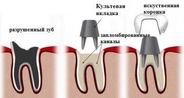 protezirovaniye kultevimi vkladkami