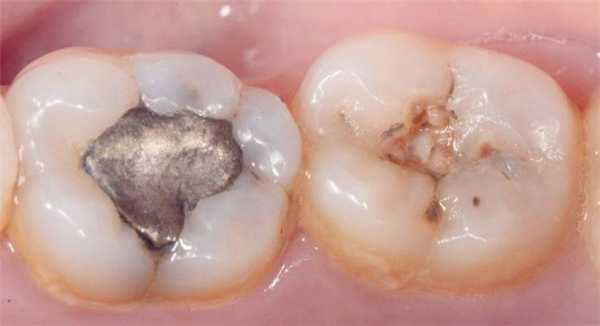 Упрощенная техника послойного моделирования успешных дистальных реставраций