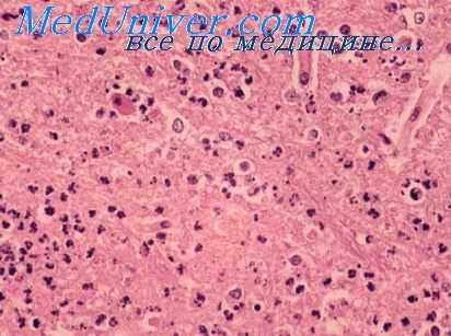 энцефаломиелит лошадей