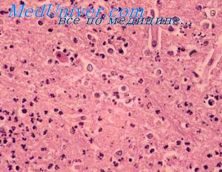 энцефаломиелит лошадей