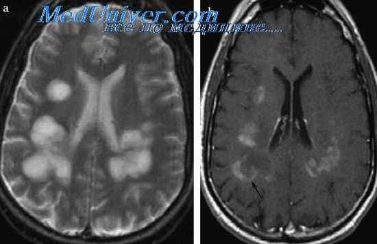 восточный энцефаломиелит
