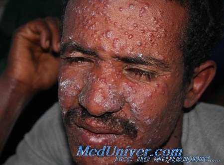 лейшманиоз