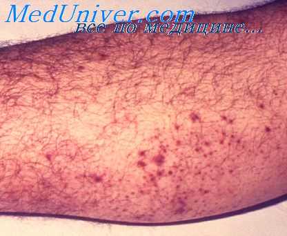 возбудитель чумы