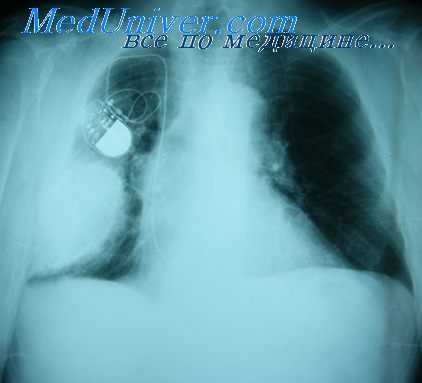 эмпиема плевры