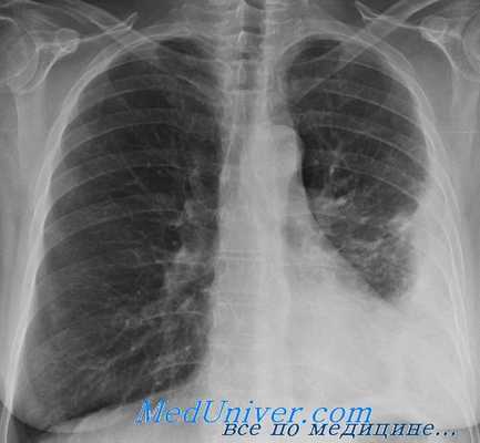 эмпиема плевры