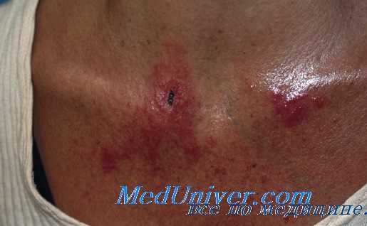 ожог кожи кислотой