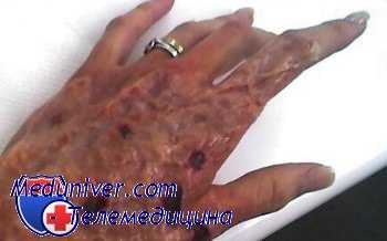 воздействие смол на кожу