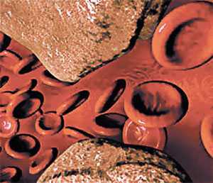 Возрастные изменения артерий. Атеросклероз