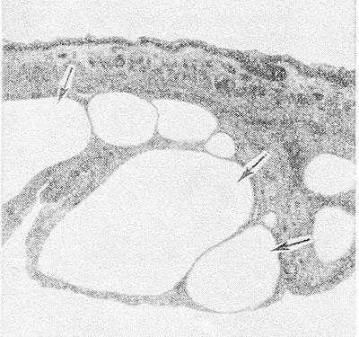 Микропрепарат толстой кишки при пневматозе: под серозной оболочкой кишки видны многочисленные воздушные кисты (стрелками указаны крупные кисты); окраска гематоксилин-эозином; х 40.