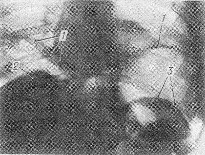 Рис. 1. Рентгенограмма брюшной полости в норме после наложения диагностического пневмоперитонеума (в вертикальном положении больного): правый и левый куполы диафрагмы (1), верхняя поверхность печени (2) И верхненаружный контур селезенки (3).