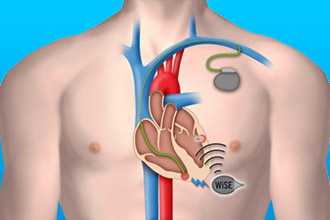 Лечение осложнений инфаркта миокарда