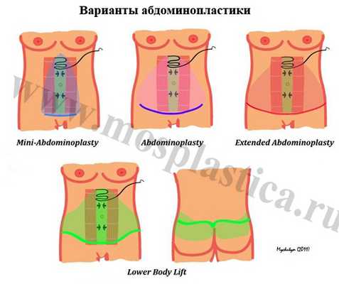 Абдоминопластика операция