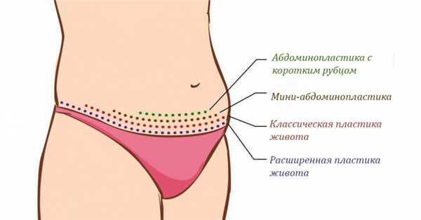 Виды абдоминопластики