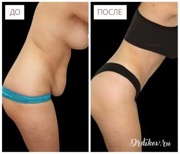 Абдоминопластика. Фото до-после операции