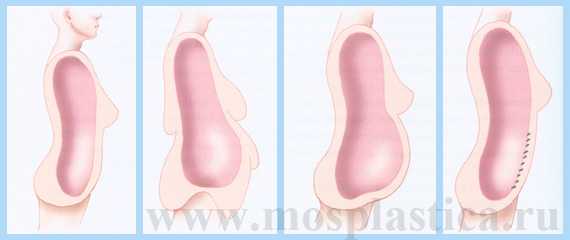 абдоминопластика живота