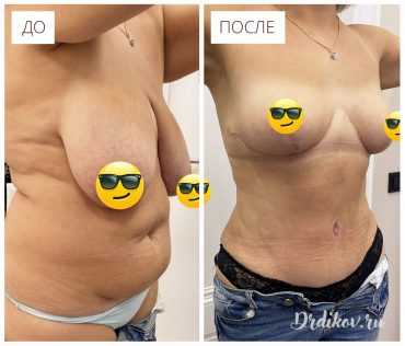 Абдоминопластика. Фото до-после операции