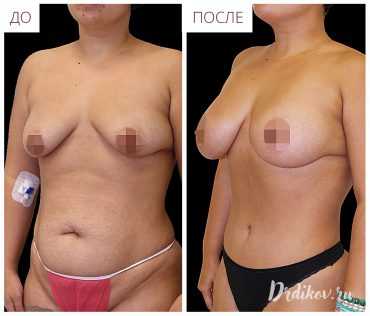 Абдоминопластика и липосакция