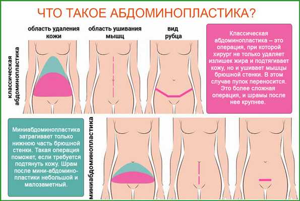 Что такое абдоминопластика