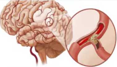церебральная ангиография