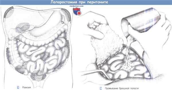 Этапы и техника лапаростомии при перитоните
