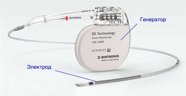 как устроен кардиостимулятор