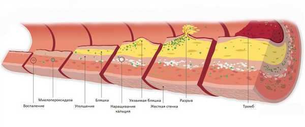 атероскр.jpg