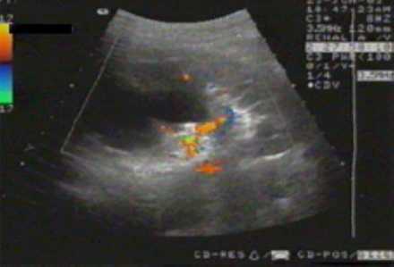 Эходопплерограмма. Снижение интенсивности кровотока в области истонченной паренхимы верхнего и среднего сегментов почки.