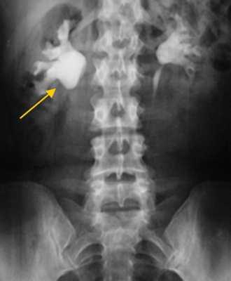 Экскреторная урограмма. Стеноз лоаночно-мочеточникового сегмента, гидронефроз справа.