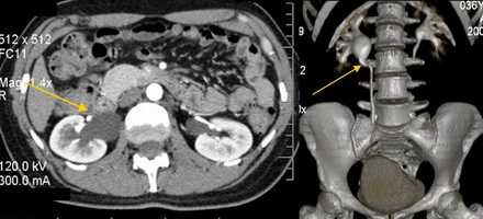 Мультиспиральная компьютерная томография. 3D реконструкция. Стеноз лоханочно-мочеточникового сегмента, гидронефроз справа.