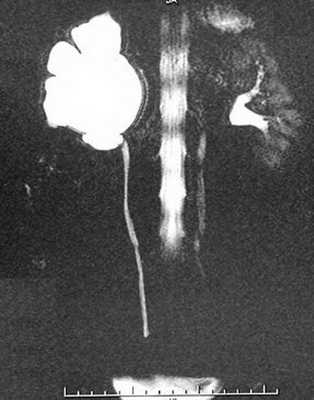 Магнитно-резонансная урография. Стеноз лоханочно-мочеточникового сегмента, гидронефроз справа.