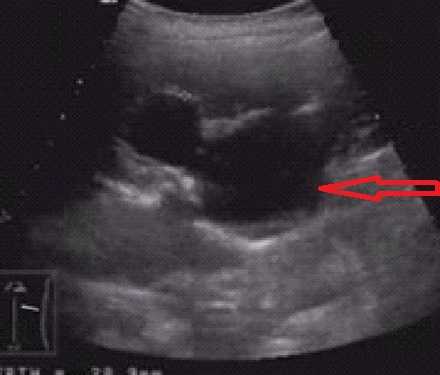 Ультразвуковое исследование. Диалатация чашечно-лоханочной системы.