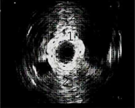 Эндолюминальная эхосонограмма зоны лоханочно-мочеточникового сегмента
