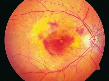 Возрастная макулярная дегенерация: влажная форма