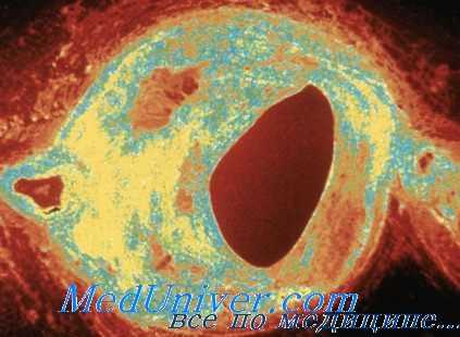 атеросклероз