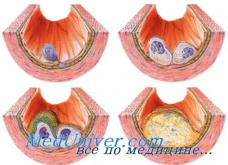 атеросклероз