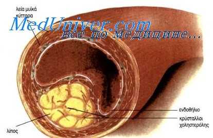 атеросклероз