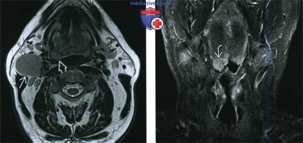 КТ, МРТ при ВПЧ-обусловленном плоскоклеточном раке ротоглотки