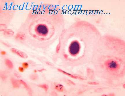 Возбудитель цитомегаловирусной инфекции