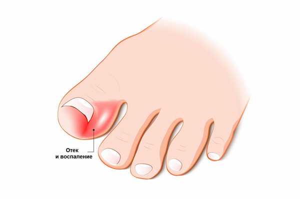 Вросший ноготь, как лечить и сколько стоит в Красногорске, Нахабино