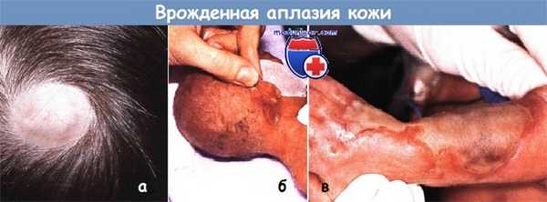 Врожденная аплазия кожи у новорожденного