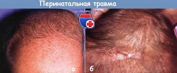 Перинатальная травма у новорожденного
