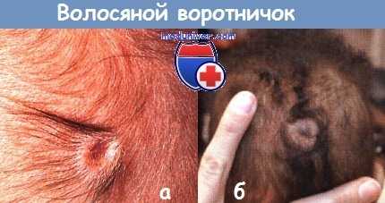 Волосяной воротничок у новорожденного