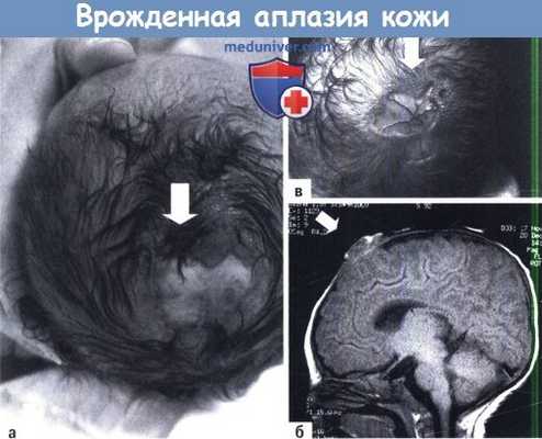 Врожденная аплазия кожи