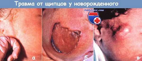 Травмы от щипцов у новорожденного
