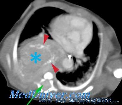 нейробластома у детей