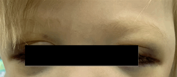 Рис. 3. Симптом «очков» при метастазах в орбиту