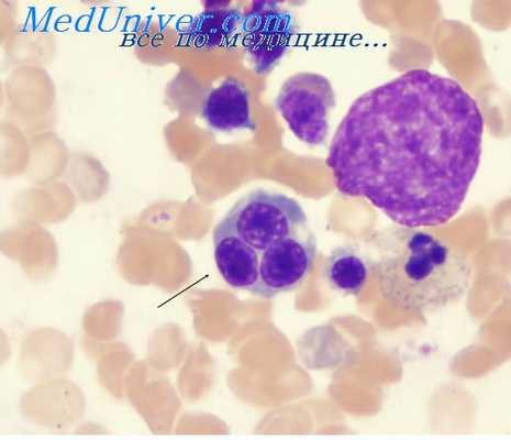 врожденная порфирия